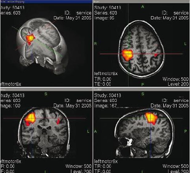Computertomografie von Gehirnaktivitäten